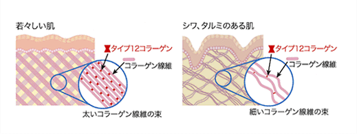 タイプ12コラーゲンの影響